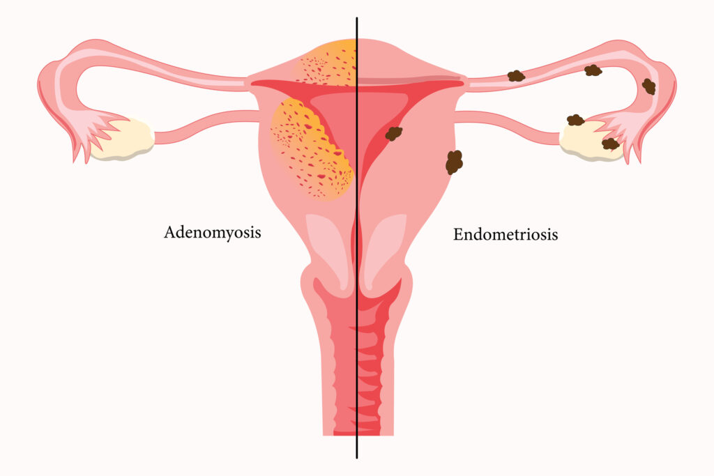 Adenomyosis and Endometriosis
